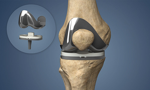 Joint Replacement